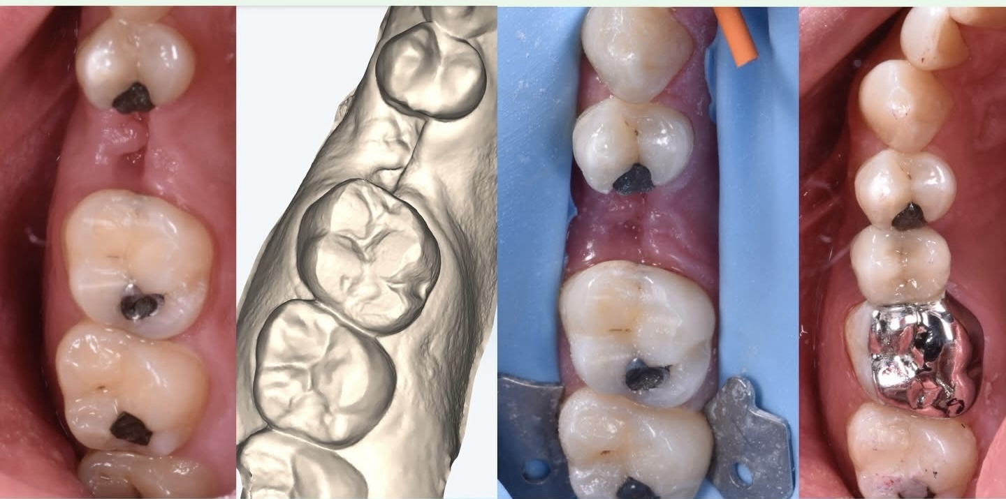 Stages of restorative bridge treatment