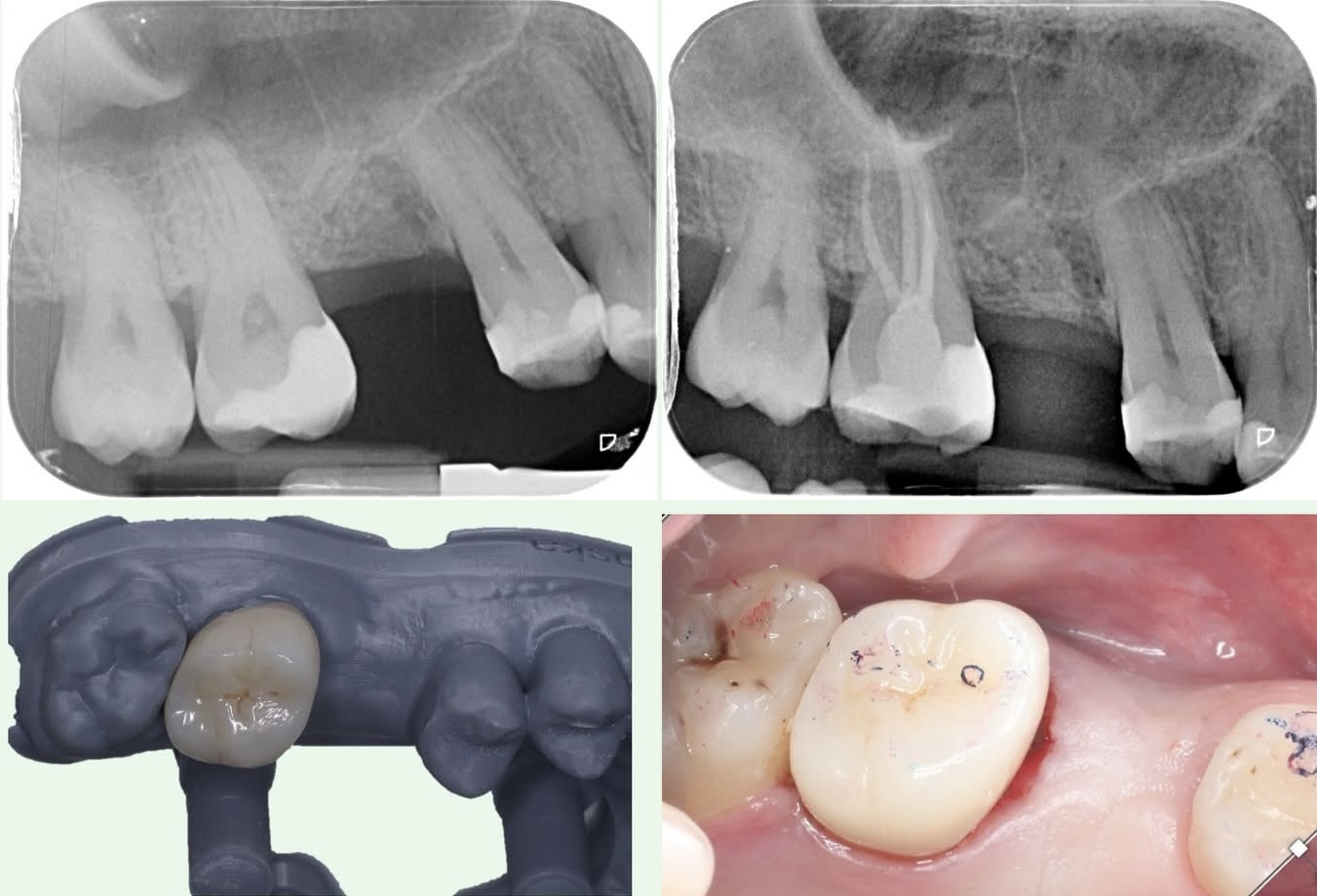 Root canal treatment followed by full cuspal coverage